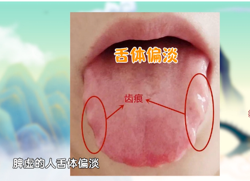 手上一个部位，看出你是否有湿气！按摩一个穴位，健脾祛湿