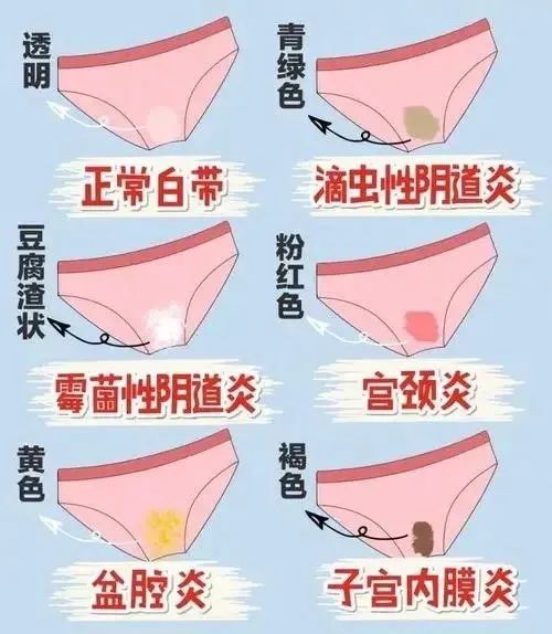 常见的妇科炎症有哪些？